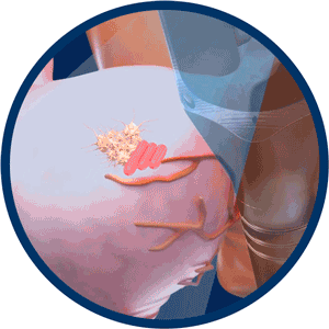 Robotic HIFU Treatment